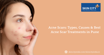Acne scar treatment in Pune