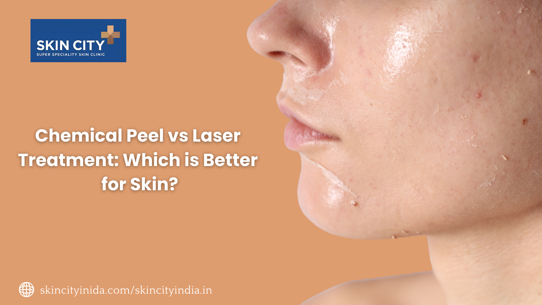 Chemical Peel vs Laser Treatment: Which is Better for Skin?