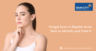 Fungal acne and regular acne treatment