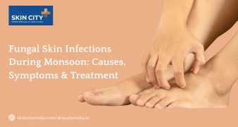 Fungal skin infection treatment in Pune