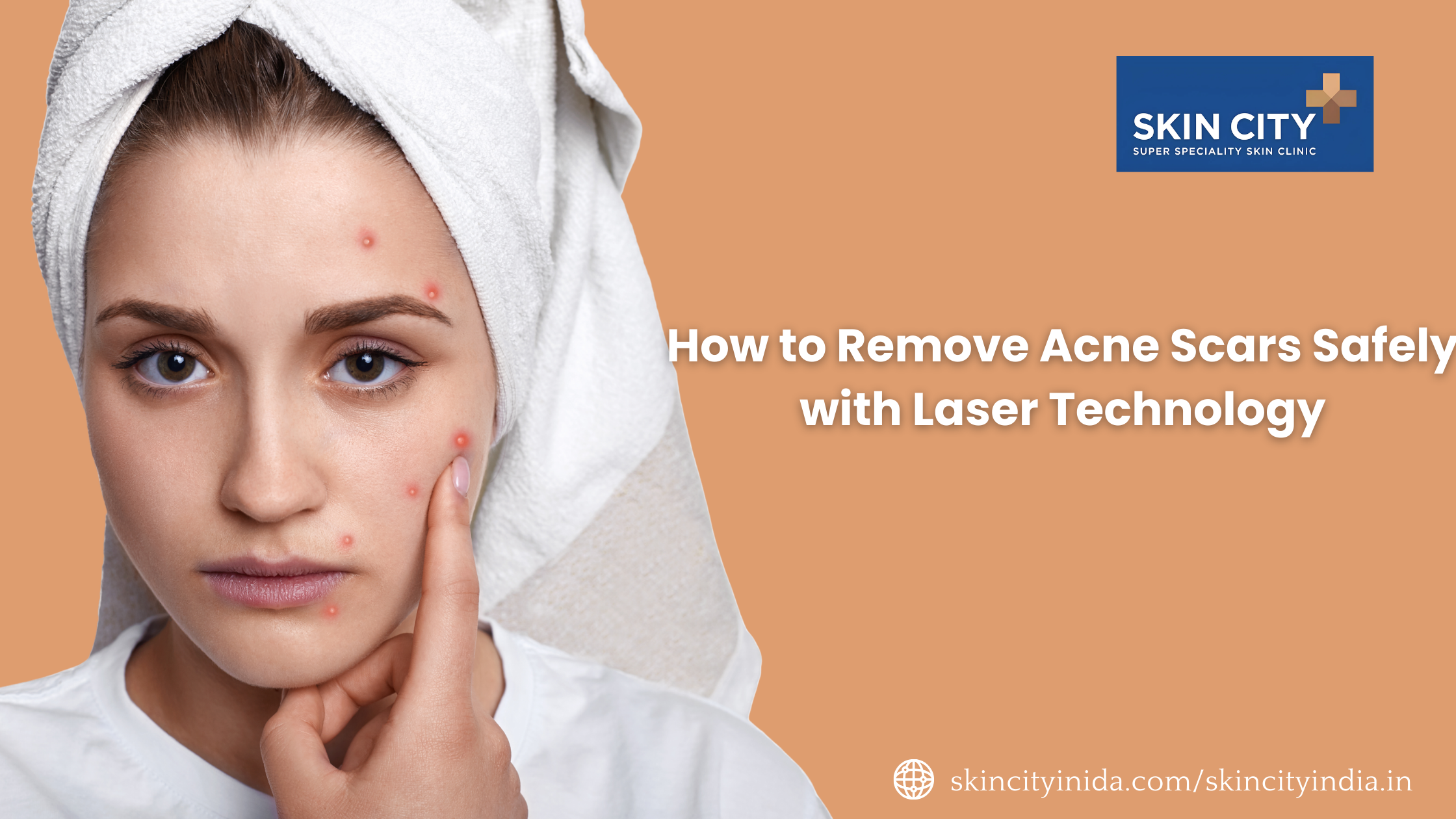 How to Remove Acne Scars Safely with Laser Technology