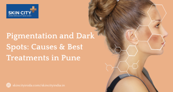 Pigmentation treatment in Pune