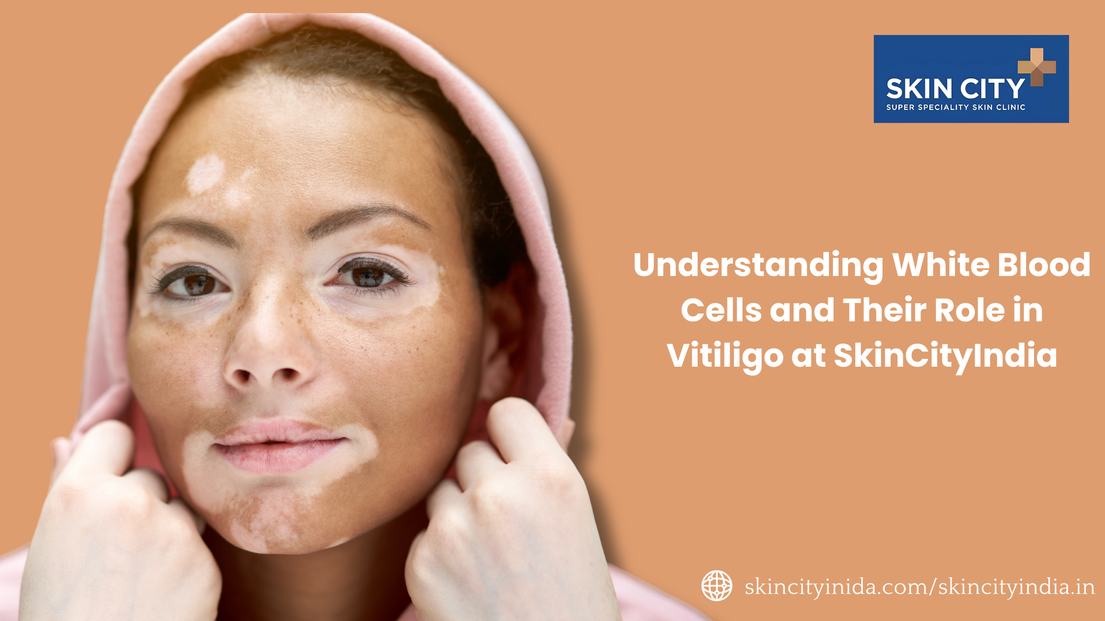 Vitiligo Treatment in India: Latest Medical and Laser Solutions